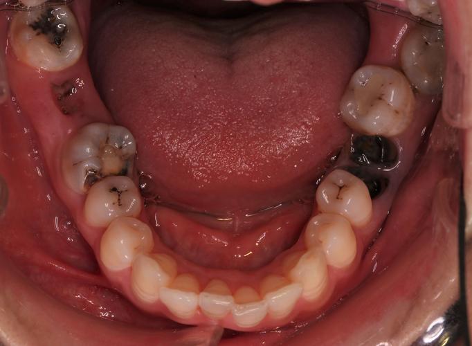 广州牙齿矫正效果怎样？价格贵不贵？-图3