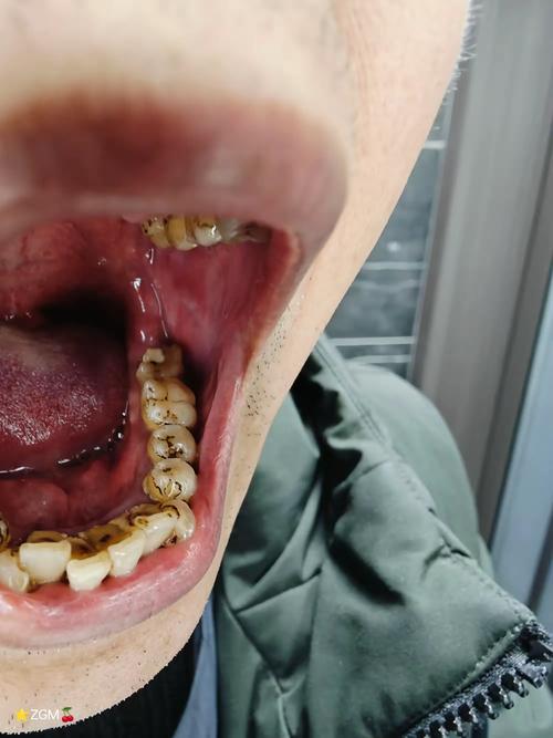 牙齿矫正牙齿掉了,这是怎么回事?-图2 牙齿矫正牙齿掉了,这是怎么回事?-图2