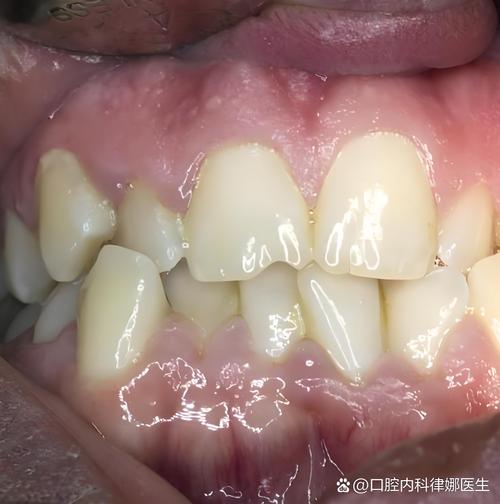 牙齿矫正牙齿掉了,这是怎么回事?-图3 牙齿矫正牙齿掉了,这是怎么回事?-图3