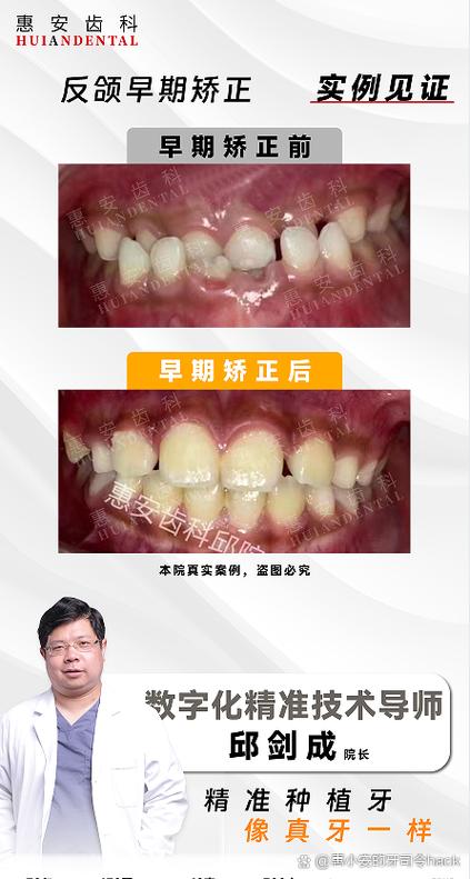 牙齿矫正美学矫正-图1 牙齿矫正美学矫正-图1