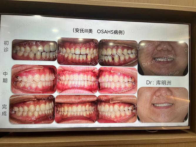 牙齿矫正美学矫正-图3 牙齿矫正美学矫正-图3