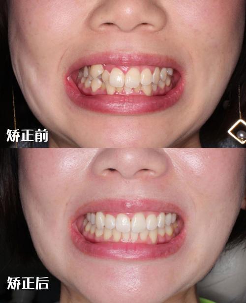 矫正下面一排牙齿效果如何？-图2