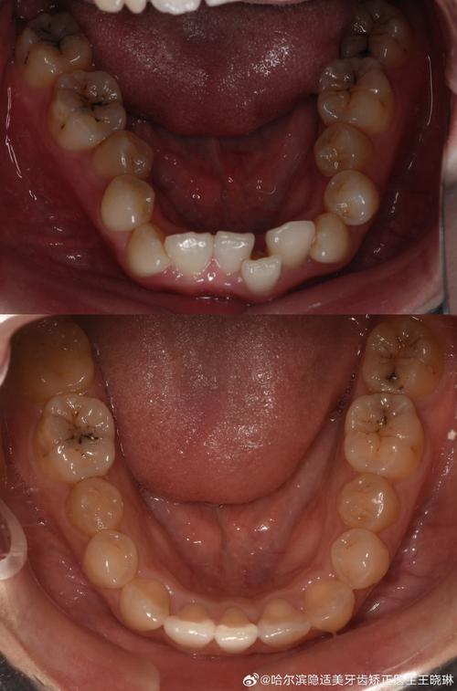 最后一颗牙齿矫正，矫正后需要注意哪些问题？-图3