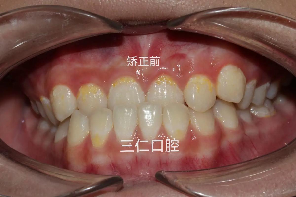 反合牙齿矫正视频真能改善地包天吗？-图2