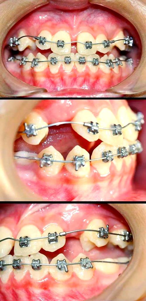 反合牙齿矫正视频真能改善地包天吗？-图3
