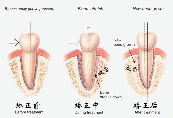 牙齿矫正上下移动-图2