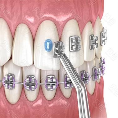 鄂尔多斯矫正牙齿效果怎么样?-图1 鄂尔多斯矫正牙齿效果怎么样?-图1
