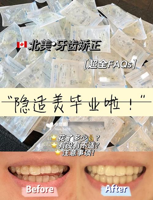 隐形牙齿矫正哪好-图3