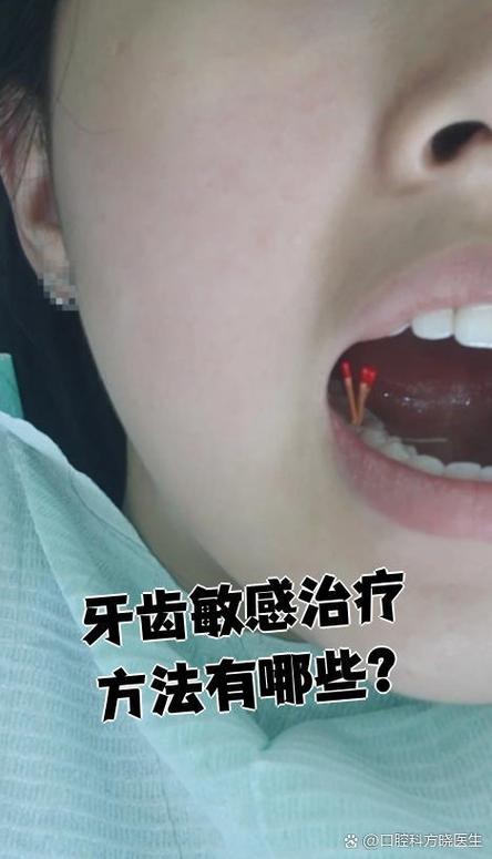 矫正期间牙齿敏感-图3