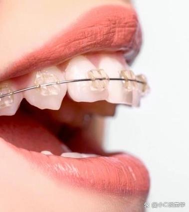 苏州陶瓷牙齿矫正-图1 苏州陶瓷牙齿矫正-图1
