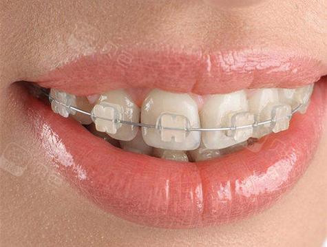 苏州陶瓷牙齿矫正-图3 苏州陶瓷牙齿矫正-图3
