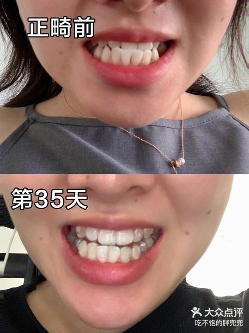 牙齿矫正后为何会大小脸？如何改善与预防？-图3