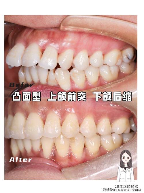 牙齿矫正上颚图片能看懂哪些矫正关键变化？-图1