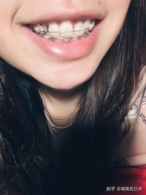 20岁矫正牙齿还来得及吗？效果会受年龄影响吗？-图2