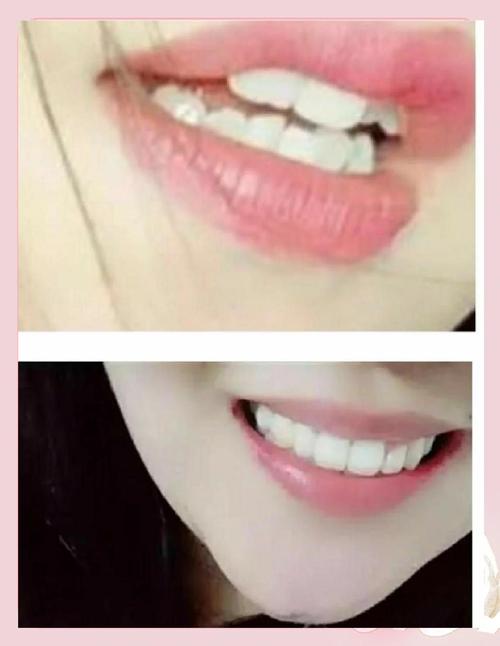 27岁女牙齿矫正-图1 27岁女牙齿矫正-图1