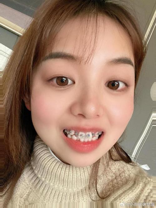 27岁女牙齿矫正-图2 27岁女牙齿矫正-图2