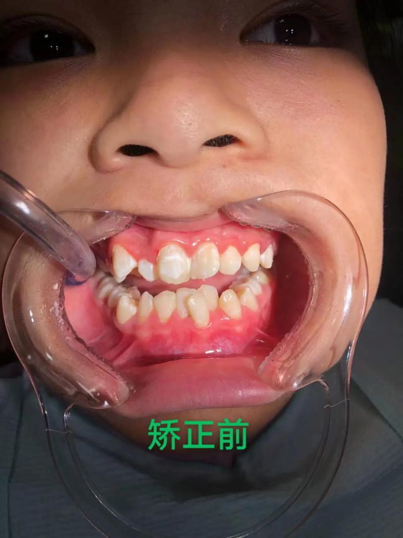 矫正牙齿时没拔智齿，会影响矫正效果吗？-图2