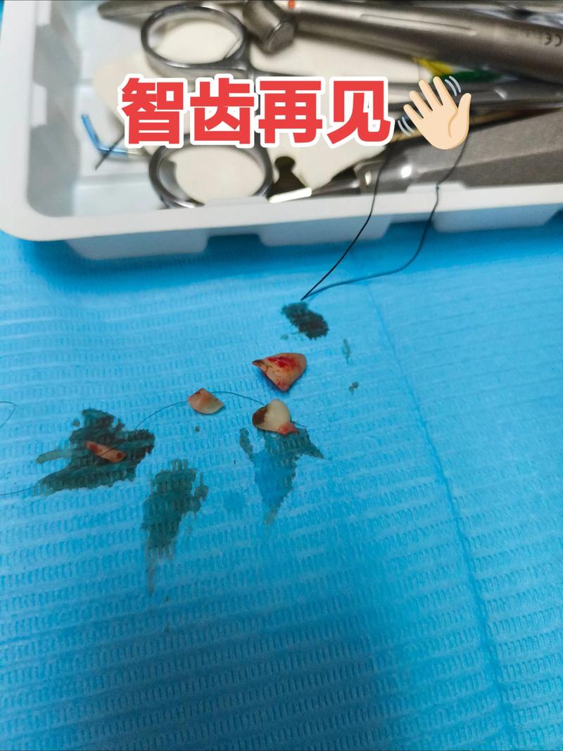 矫正牙齿时没拔智齿，会影响矫正效果吗？-图3