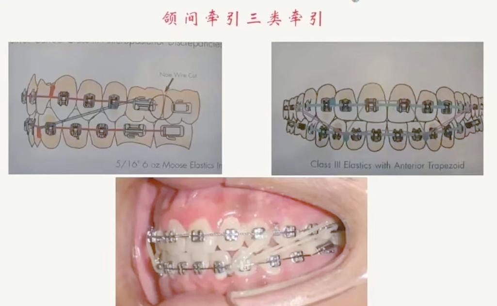 牙齿矫正为何需要精细调整？这阶段要注意哪些细节？-图2