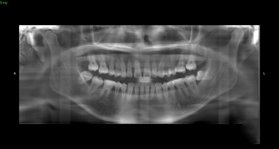 矫正牙齿没有拍片-图1