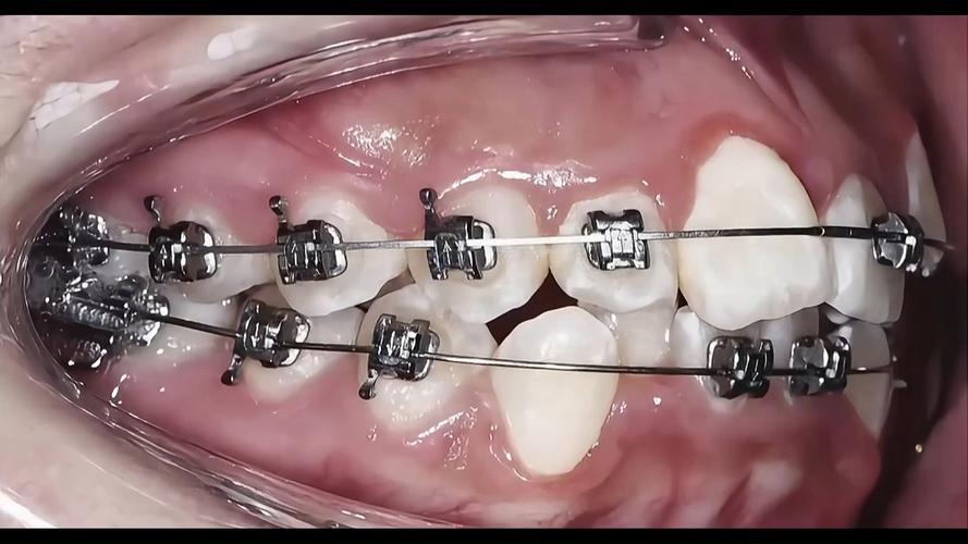 矫正牙齿手术视频能看吗？安全性和效果如何？-图1