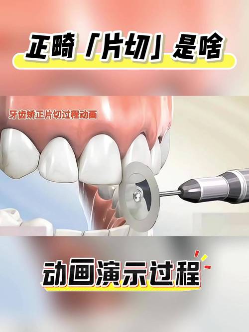 矫正牙齿手术视频能看吗？安全性和效果如何？-图2