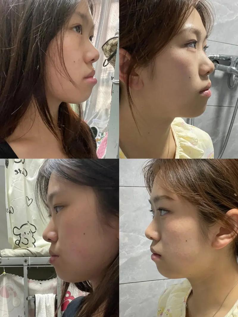 牙齿矫正地包天，最佳矫正时机是几岁？-图2