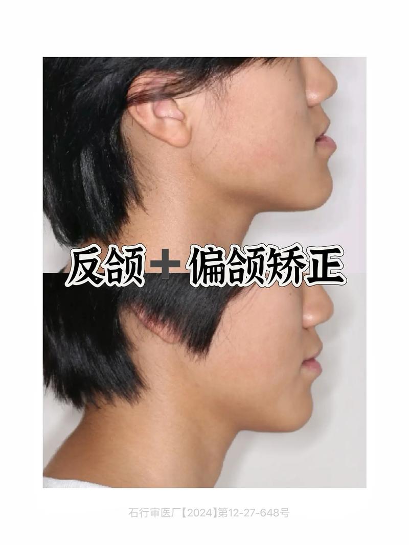 矫正牙齿会导致颧骨变宽吗？-图1