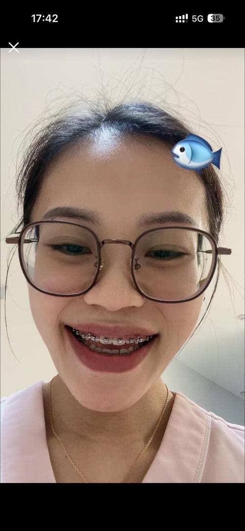 牙齿矫正 33岁-图1 牙齿矫正 33岁-图1