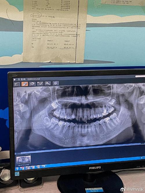 矫正牙齿需要拍片-图2