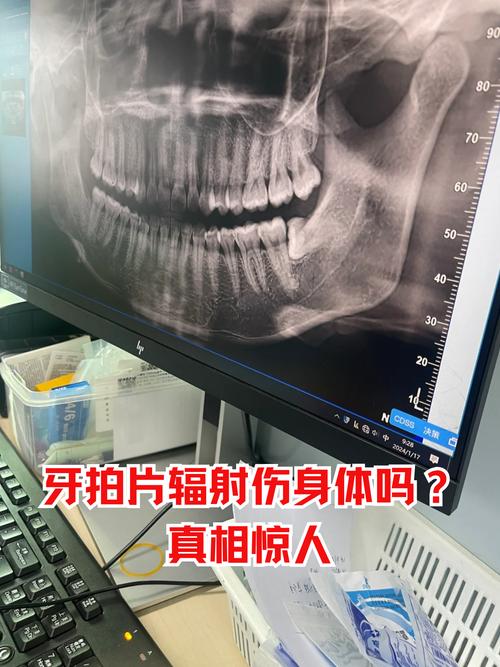 矫正牙齿需要拍片-图3
