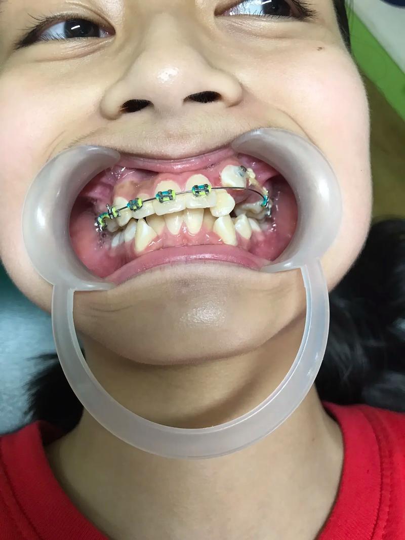 乌鲁木齐矫正牙齿效果如何？价格贵不贵？-图3