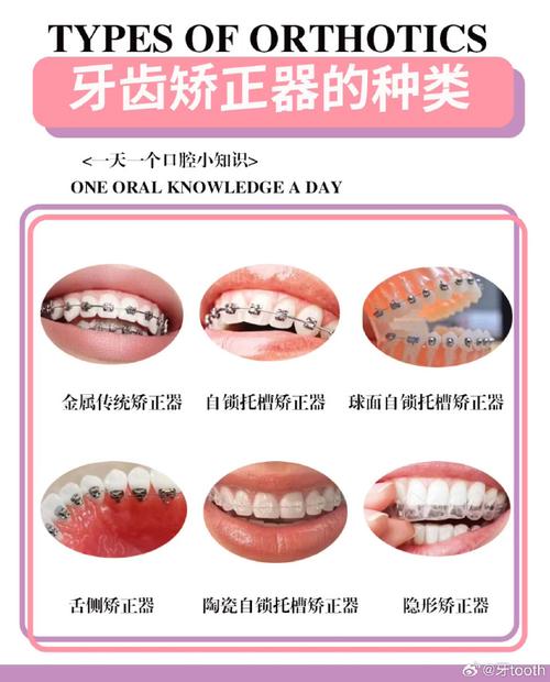 牙齿矫正器怎么摘？不同矫正器的摘取步骤有何不同？-图1