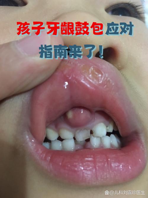 牙齿矫正后牙龈肿-图2