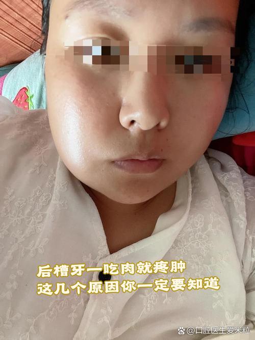 牙齿矫正后牙龈肿-图1