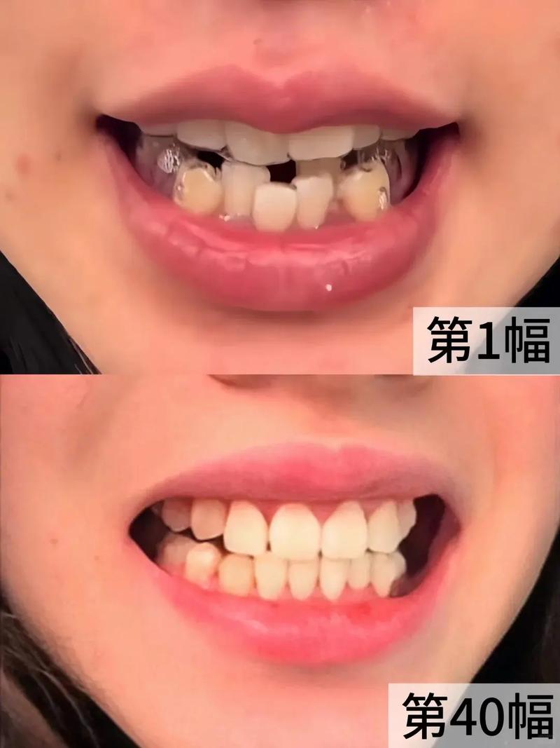 隐形矫正牙齿会疼吗？-图2