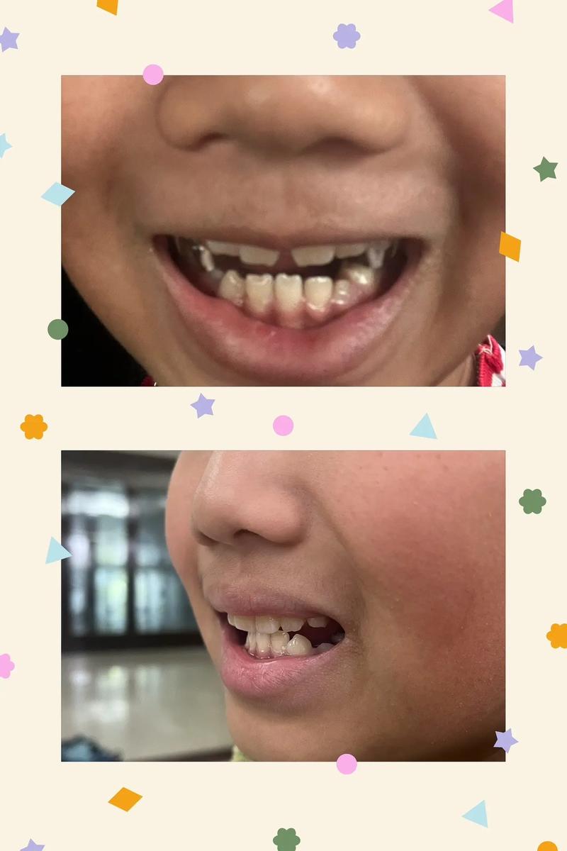 牙齿矫正后天包地-图2