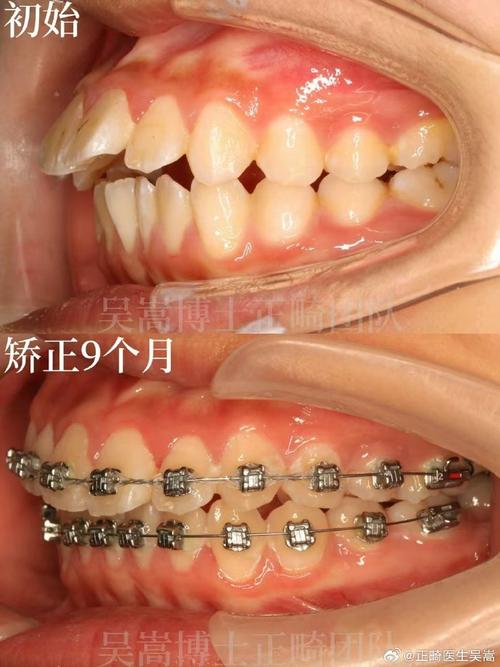 门牙前凸矫正，如何选择适合自己的矫正方法以达到最佳效果？-图3
