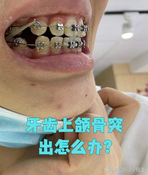 门牙前凸矫正，如何选择适合自己的矫正方法以达到最佳效果？-图2