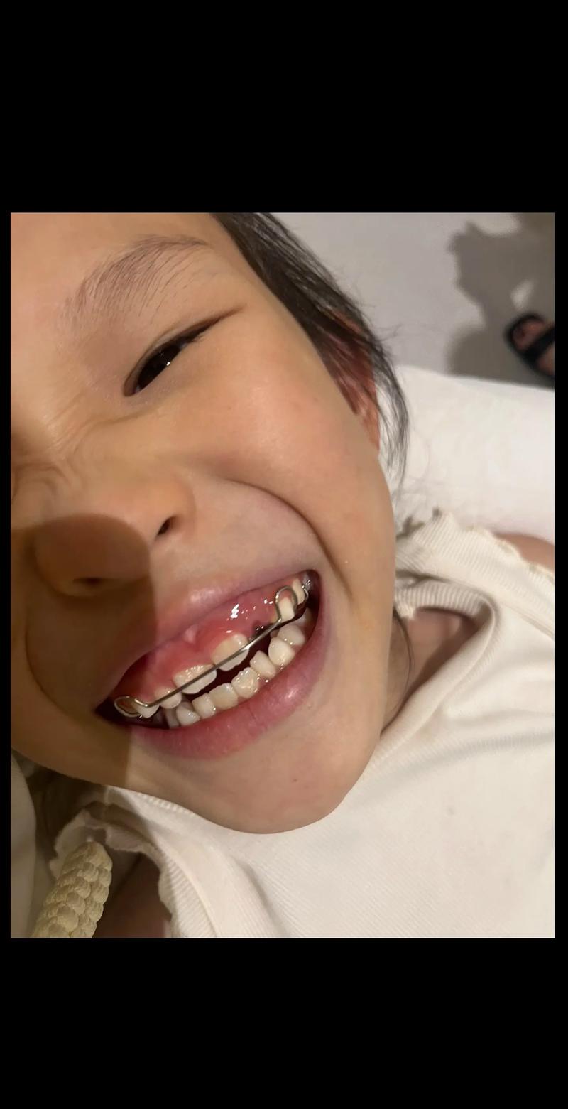 一小时矫正牙齿可行吗？效果安全吗？-图1