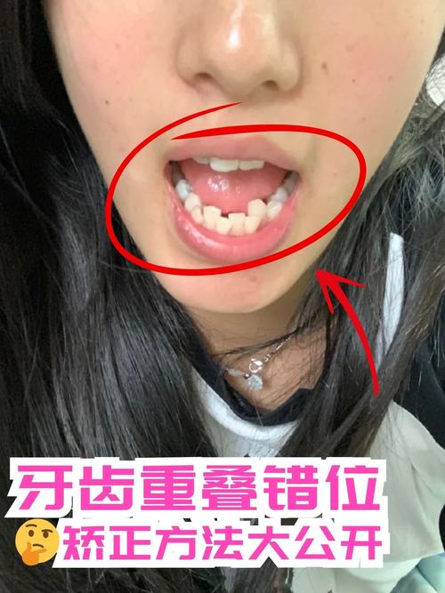 矫正牙齿过程中牙齿越来越歪,到底是什么原因导致的?-图2 矫正牙齿过程中牙齿越来越歪,到底是什么原因导致的?-图2