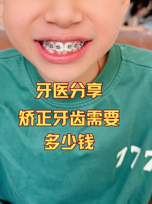 矫正牙齿用分牙吗-图1