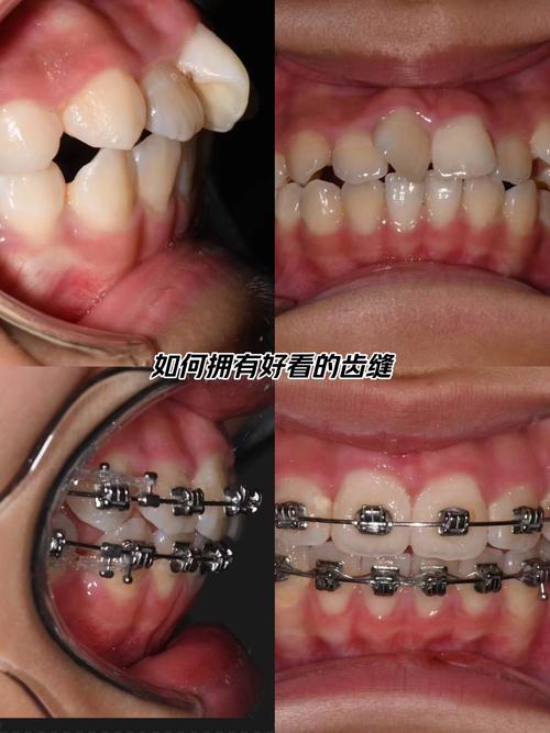 嘴凸矫正前后对比图片真实吗？-图3