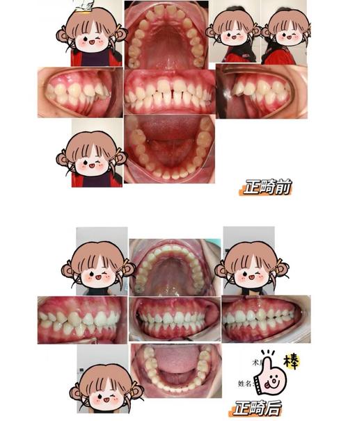 牙齿矫正中大牙后移有何作用？过程和注意事项有哪些？-图2