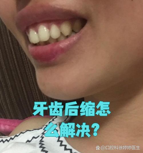 牙齿矫正中大牙后移有何作用？过程和注意事项有哪些？-图3