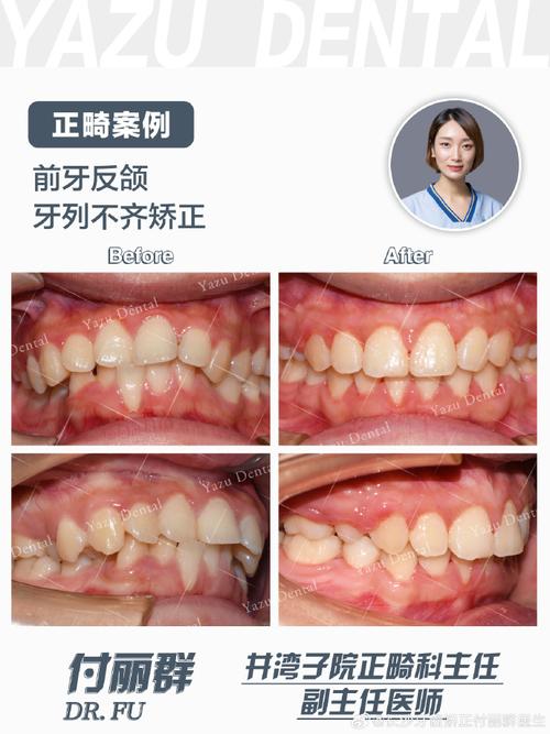 长沙矫正牙齿哪好-图3