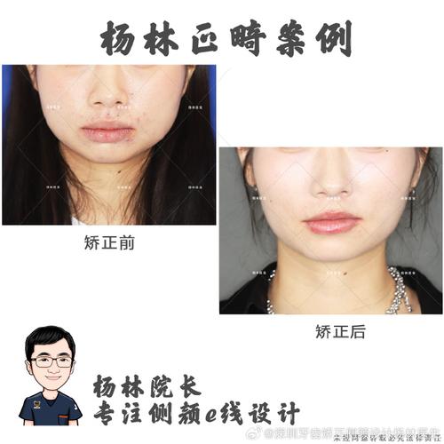 深圳矫正牙齿贵吗-图1 深圳矫正牙齿贵吗-图1