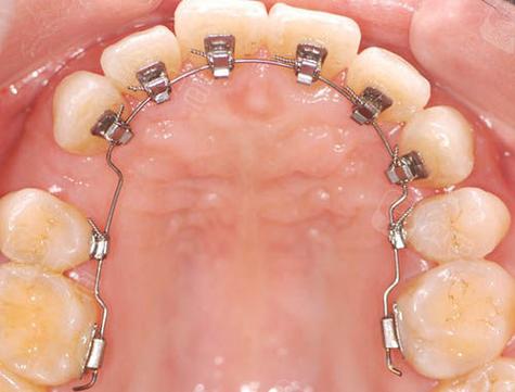 舌侧矫正对牙齿咬合的调整效果具体如何?-图2 舌侧矫正对牙齿咬合的调整效果具体如何?-图2