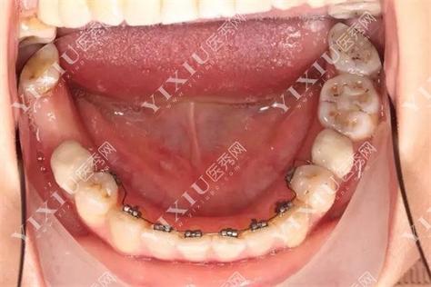 舌侧矫正对牙齿咬合的调整效果具体如何?-图3 舌侧矫正对牙齿咬合的调整效果具体如何?-图3
