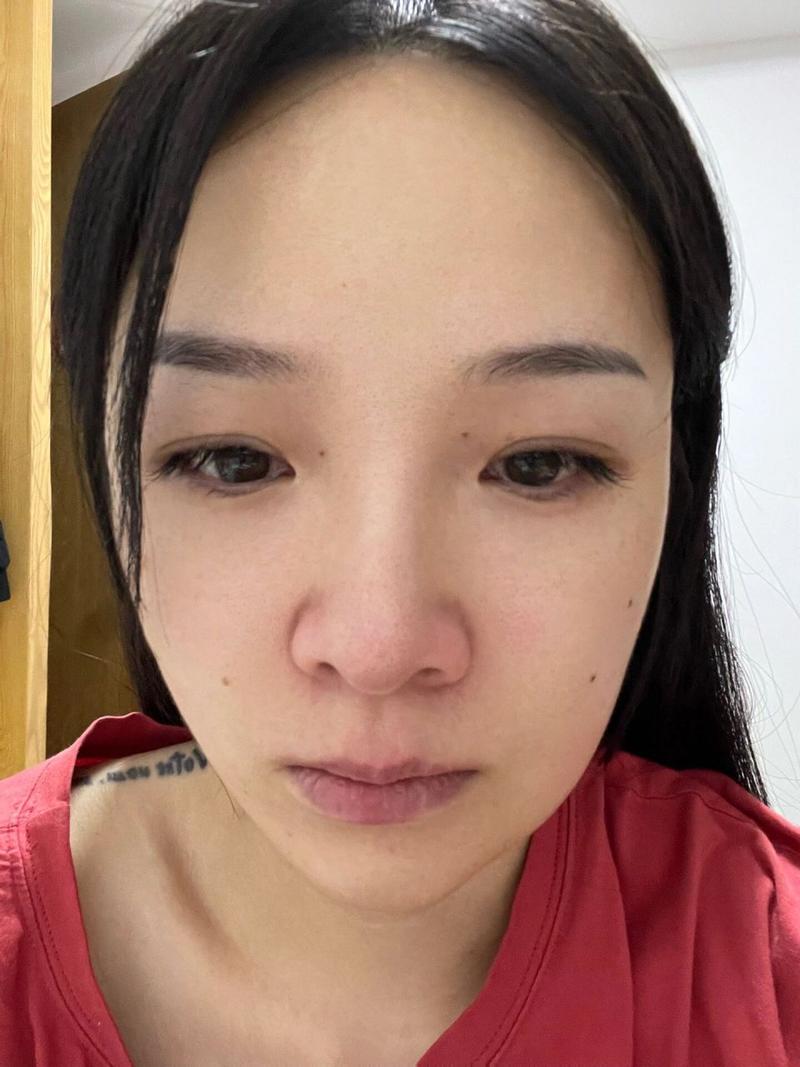 牙齿矫正后脸肿了？是正常反应还是需警惕？-图1